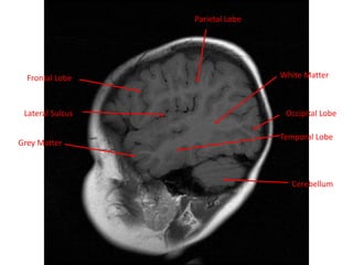 White Matter
Cerebellum
Grey Matter
Frontal Lobe
Parietal Lobe
Temporal Lobe
Lateral Sulcus Occipital Lobe
 
