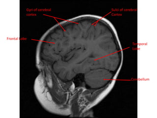Gyri of cerebral
cortex
Sulci of cerebral
Cortex
Cerebellum
Frontal Lobe
Temporal
Lobe
 