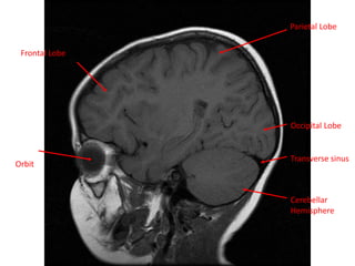 Frontal Lobe
Parietal Lobe
Orbit
Occipital Lobe
Transverse sinus
Cerebellar
Hemisphere
 