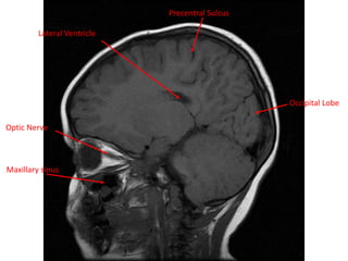 Optic Nerve
Precentral Sulcus
Lateral Ventricle
Occipital Lobe
Maxillary sinus
 