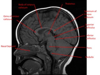 Splenium of
Corpus
callosumGenu of corpus
callosum
Pons
Superior
Colliculus
Inferior
Colliculus
NasalNasal Septuml
Medulla
Body of corpus
callosum
Thalamus
 