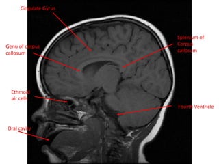 Cingulate Gyrus
Genu of corpus
callosum
Ethmoid
air cells
Oral cavity
Splenium of
Corpus
callosum
Fourth Ventricle
 