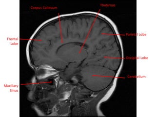 Frontal
Lobe
Maxillary
Sinus
Parietal Lobe
Occipital Lobe
Corpus Callosum
Thalamus
Cerebellum
 