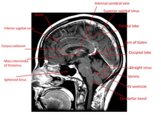 . Bone
Inferior sagittal sinus
Corpus callosum
Internal cerebral vein
Vein of Galen
Superior sagittal sinus
Parietal lobe
Occipital lobe
Straight sinus
. Vermis
. IV ventricle
Cerebellar tonsil
Mass intermedia
of thalamus
Sphenoid Sinus
 