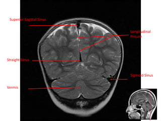 Longitudinal
Fissure
Straight Sinus
Superior Sagittal Sinus
Sigmoid Sinus
Vermis
 