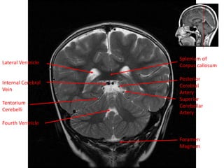 Splenium of
Corpus callosum
Posterior
Cerebral
Artery
Superior
Cerebellar
Artery
Foramen
Magnum
Lateral Ventricle
Internal Cerebral
Vein
Tentorium
Cerebelli
Fourth Ventricle
 