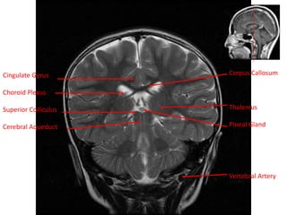 Cingulate Gyrus
Choroid Plexus
Superior Colliculus
Cerebral Aqueduct
Corpus Callosum
Thalamus
Pineal Gland
Vertebral Artery
 
