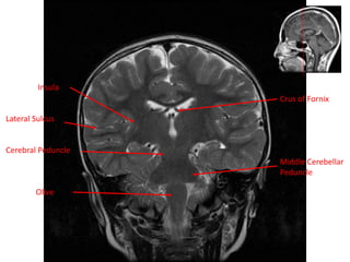 Insula
Lateral Sulcus
Cerebral Peduncle
Olive
Crus of Fornix
Middle Cerebellar
Peduncle
 