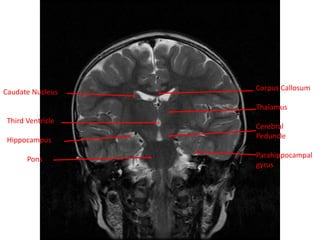 Caudate Nucleus
Third Ventricle
Hippocampus
Pons
Corpus Callosum
Thalamus
Cerebral
Peduncle
Parahippocampal
gyrus
 