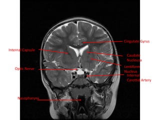 Internal Capsule
Cingulate Gyrus
Optic Nerve
Nasopharynx
Internal
Carottid Artery
Lentiform
Nucleus
Caudate
Nucleusa
 