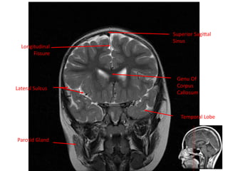 Longitudinal
Fissure
Superior Sagittal
Sinus
Lateral Sulcus
Parotid Gland
Genu Of
Corpus
Callosum
Temporal Lobe
 