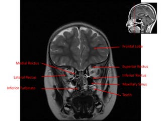 Medial Rectus
Frontal Lobe
Lateral Rectus
Inferior Turbinate
Superior Rectus
Inferior Rectus
Maxillary Sinus
Tooth
 