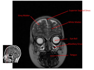 Grey Matter
Superior Sagittal Sinus
White Matter
Eye Ball
Maxillary Sinus
Tongue
 