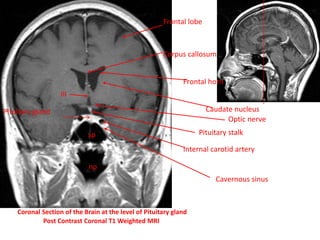 Coronal Section of the Brain at the level of Pituitary gland
Post Contrast Coronal T1 Weighted MRI
sp
np
Frontal lobe
Corpus callosum
Frontal horn
Caudate nucleus
III
Pituitary stalk
Pituitary gland
Optic nerve
Internal carotid artery
Cavernous sinus
 
