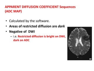 • Calculated by the software.
• Areas of restricted diffusion are dark
• Negative of DWI
– i.e. Restricted diffusion is bright on DWI,
dark on ADC
APPARENT DIFFUSION COEFFICIENT Sequences
(ADC MAP)
 