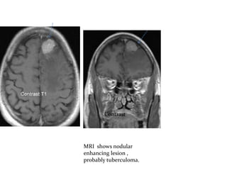 Contrast
MRI shows nodular
enhancing lesion ,
probably tuberculoma.
 