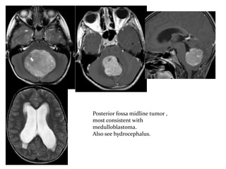 Posterior fossa midline tumor ,
most consistent with
medulloblastoma.
Also see hydrocephalus.
 