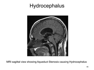 Hydrocephalus
85
MRI sagittal view showing Aqueduct Stenosis causing Hydrocephalus
 