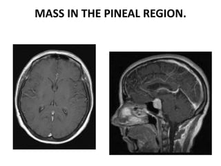 MASS IN THE PINEAL REGION.
 