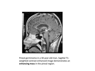 Pineal germinoma in a 30-year-old man. Sagittal T1-
weighted contrast-enhanced image demonstrates an
enhancing mass in the pineal region.
 