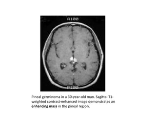 Pineal germinoma in a 30-year-old man. Sagittal T1-
weighted contrast-enhanced image demonstrates an
enhancing mass in the pineal region.
 