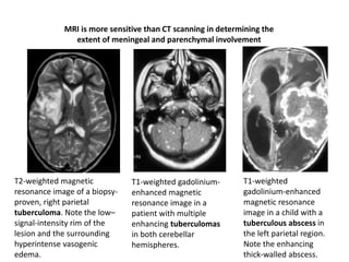 MRI is more sensitive than CT scanning in determining the
extent of meningeal and parenchymal involvement
T2-weighted magnetic
resonance image of a biopsy-
proven, right parietal
tuberculoma. Note the low–
signal-intensity rim of the
lesion and the surrounding
hyperintense vasogenic
edema.
T1-weighted gadolinium-
enhanced magnetic
resonance image in a
patient with multiple
enhancing tuberculomas
in both cerebellar
hemispheres.
T1-weighted
gadolinium-enhanced
magnetic resonance
image in a child with a
tuberculous abscess in
the left parietal region.
Note the enhancing
thick-walled abscess.
 