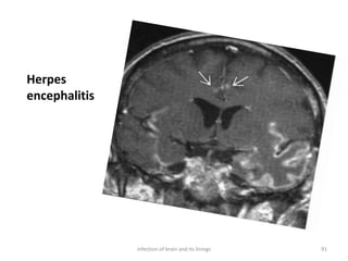 Herpes
encephalitis
91infection of brain and its linings
 