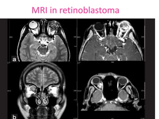 MRI in retinoblastoma
 