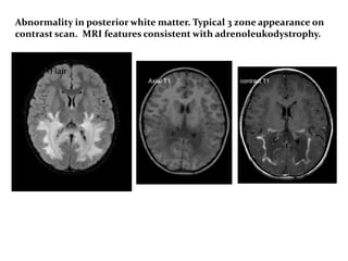 Flair
Abnormality in posterior white matter. Typical 3 zone appearance on
contrast scan. MRI features consistent with adrenoleukodystrophy.
 