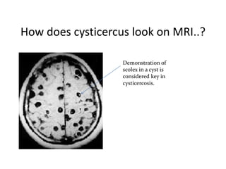 How does cysticercus look on MRI..?
Demonstration of
scolex in a cyst is
considered key in
cysticercosis.
 