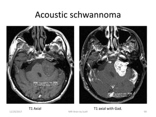 Acoustic schwannoma
T1 Axial T1 axial with Gad.
12/20/2017 99MRI Brain by Sudil
 