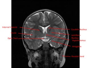 Cardunculus Brain Normal mri brain | PPTX