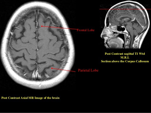 normal mri brain how to read mri brain