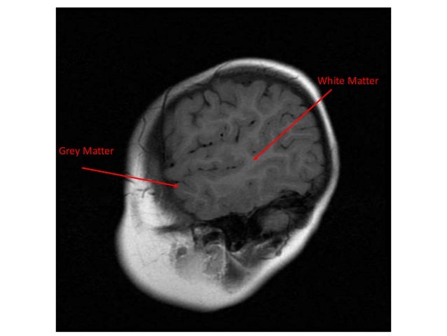 normal mri brain how to read mri brain
