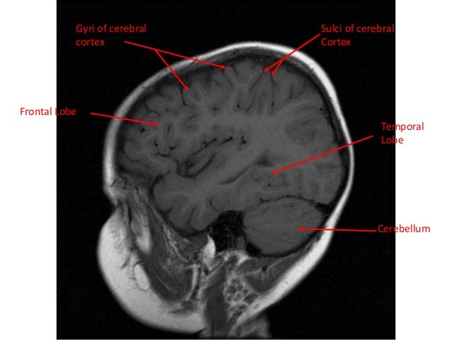 normal mri brain how to read mri brain