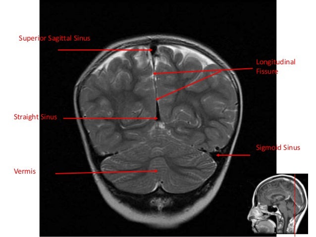 Normal mri brain