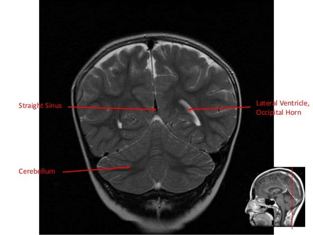 normal mri brain how to read mri brain