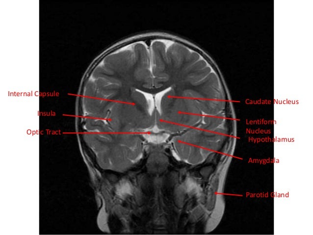 Normal mri brain