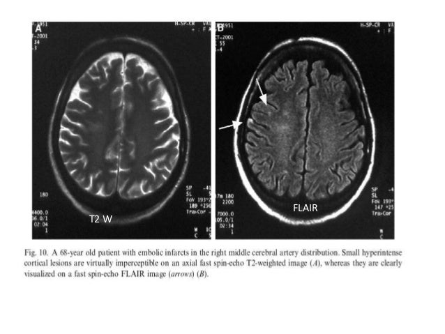 normal mri brain how to read mri brain