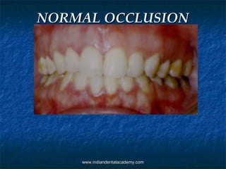 NORMAL OCCLUSIONNORMAL OCCLUSION
www.indiandentalacademy.comwww.indiandentalacademy.com
 