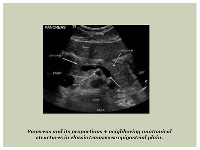 Normal pancreatic anatomy and anatomical variations | PPT