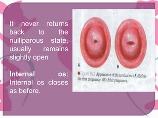 It never returns
back to the
nulliparous state,
usually remains
slightly open
Internal os:
Internal os closes
as before.
 