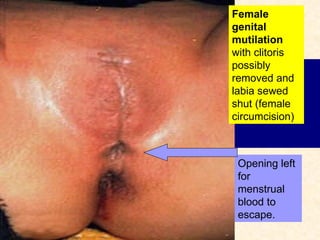 Female genital mutilation   with clitoris possibly removed and labia sewed shut (female circumcision) Opening left for menstrual blood to escape. 