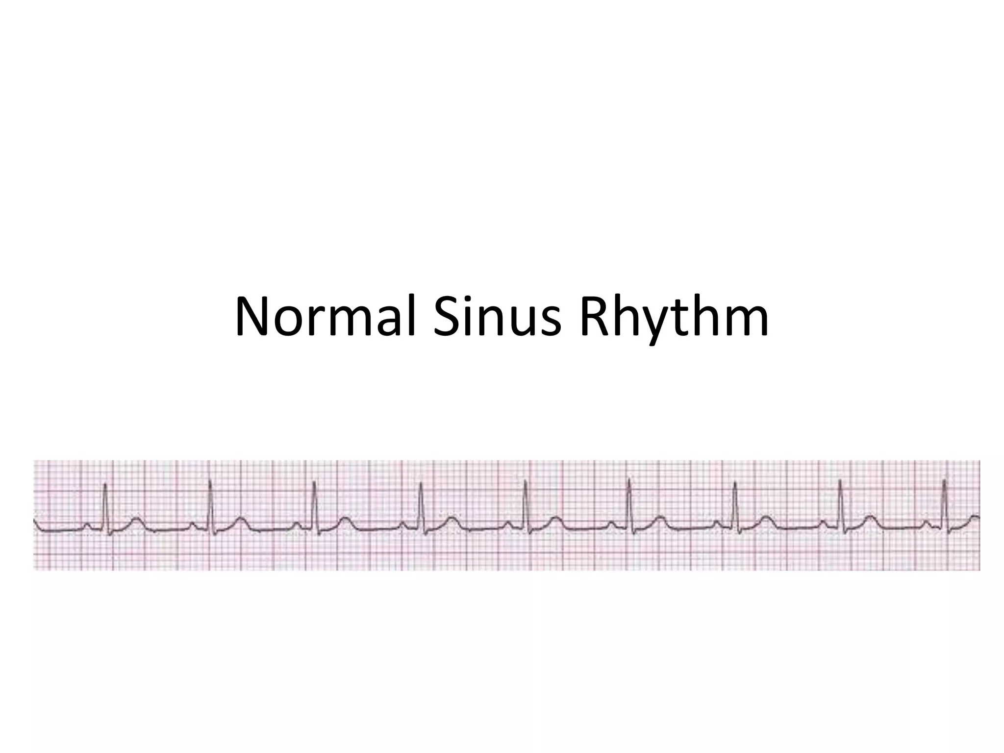 Normal Sinus Rhythm Nsr Definition – CINI