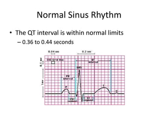 Normal Sinus Rhythm
• The QT interval is within normal limits
  – 0.36 to 0.44 seconds
 