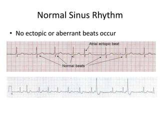Normal Sinus Rhythm
• No ectopic or aberrant beats occur
 