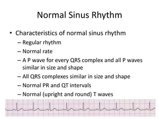 Normal Sinus Rhythm
• Characteristics of normal sinus rhythm
  – Regular rhythm
  – Normal rate
  – A P wave for every QRS complex and all P waves
    similar in size and shape
  – All QRS complexes similar in size and shape
  – Normal PR and QT intervals
  – Normal (upright and round) T waves
 