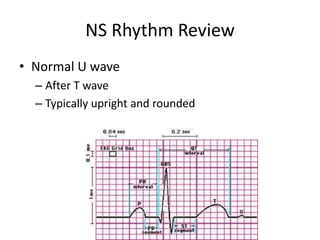 NS Rhythm Review
• Normal U wave
  – After T wave
  – Typically upright and rounded
 