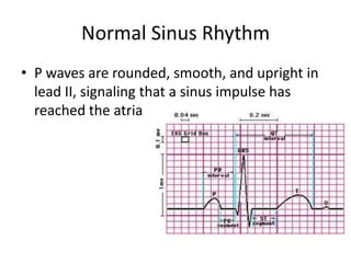 Normal Sinus Rhythm
• P waves are rounded, smooth, and upright in
  lead II, signaling that a sinus impulse has
  reached the atria
 