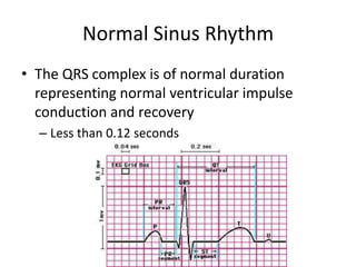 Normal Sinus Rhythm
• The QRS complex is of normal duration
  representing normal ventricular impulse
  conduction and recovery
  – Less than 0.12 seconds
 